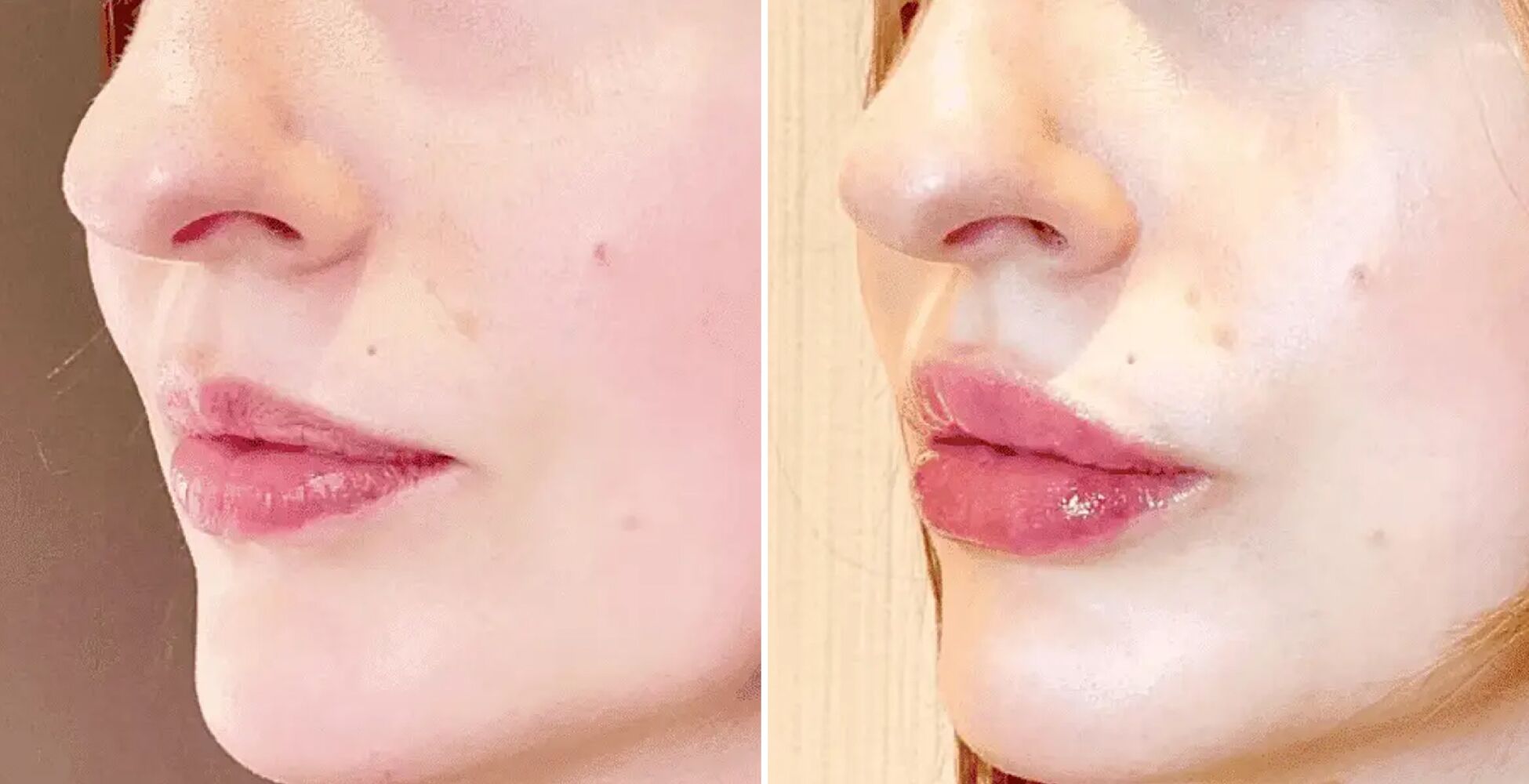 Lip Filler Las Vegas