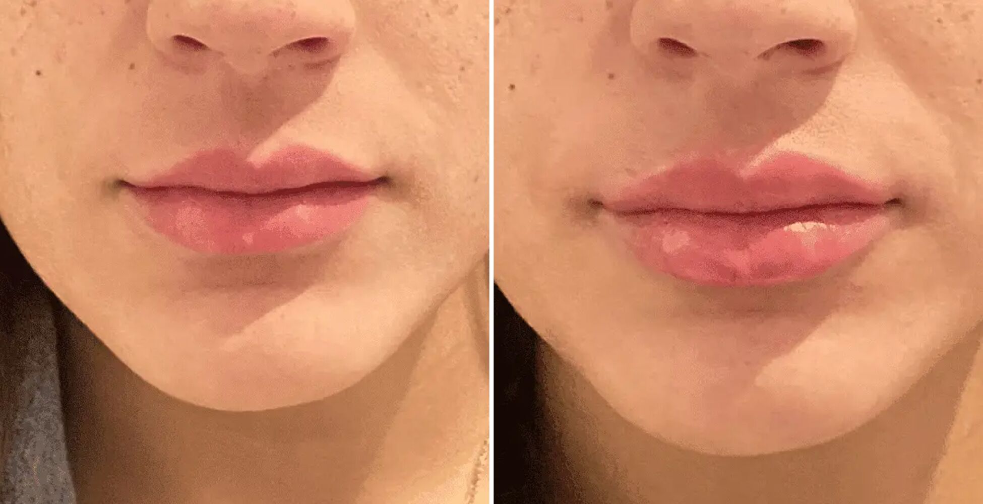 Lip Filler Las Vegas